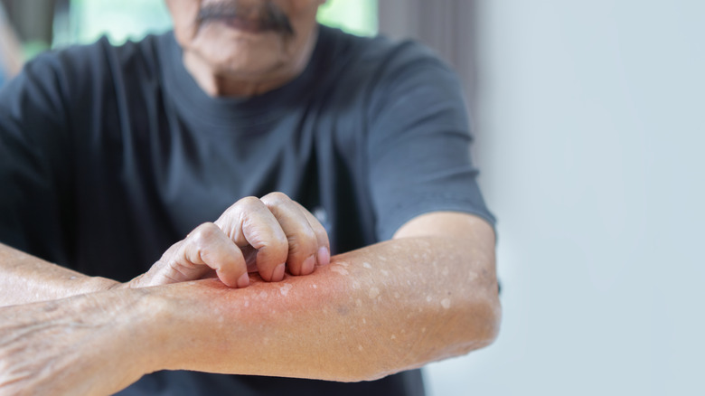 man som repar itcy arm