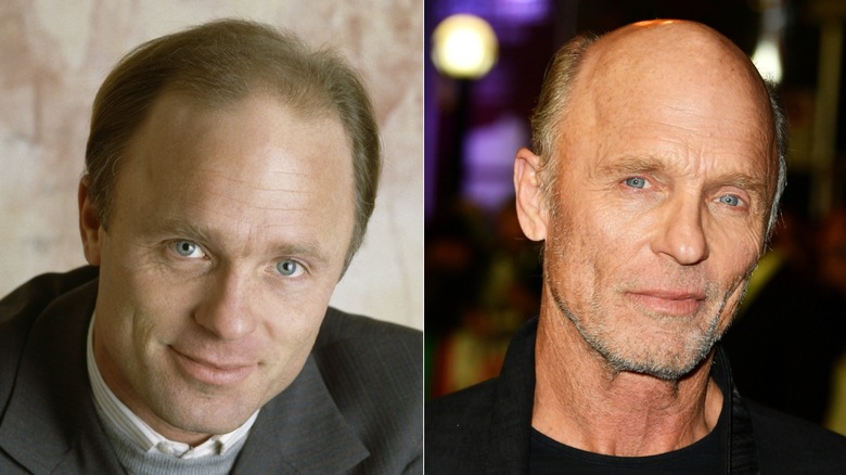Foton sida vid sida som visar Ed Harris håravfall