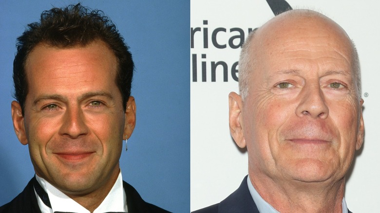 Foton sida vid sida som visar Bruce Willis håravfall