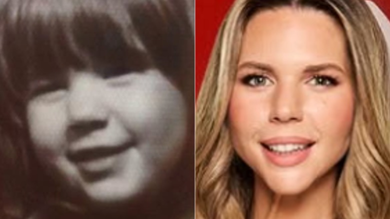 bilder på Bec Zacharia som barn med sin käkdefekt och som vuxen efter att ha åtgärdat bristen