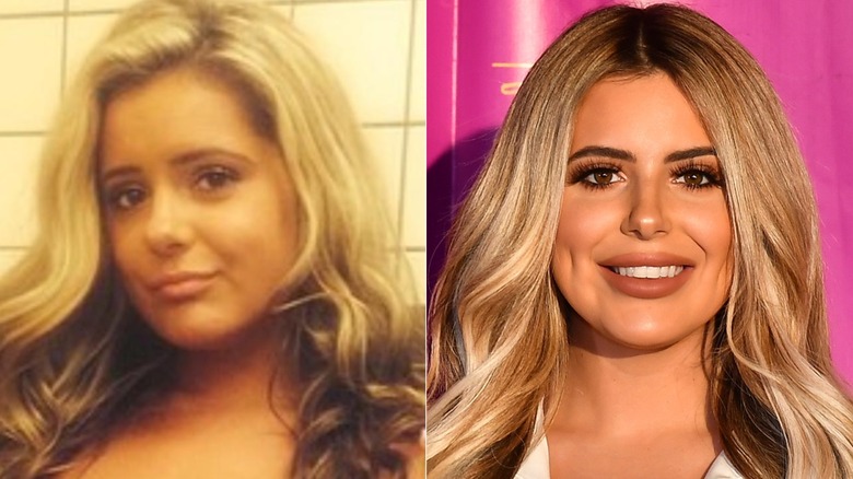 Brielle Biermann före och efter att hon korrigerade en käkbekymmer