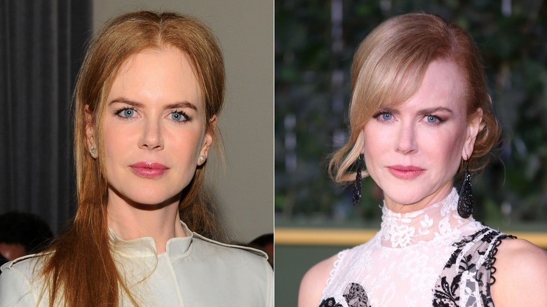 Foton sida vid sida som visar Nicole Kidman före och efter användning av Botox