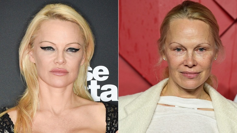 Foton sida vid sida som visar Pamela Anderson före och efter användning av Botox