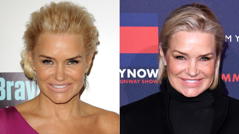 Foton sida vid sida som visar Yolanda Hadid före och efter användning av Botox