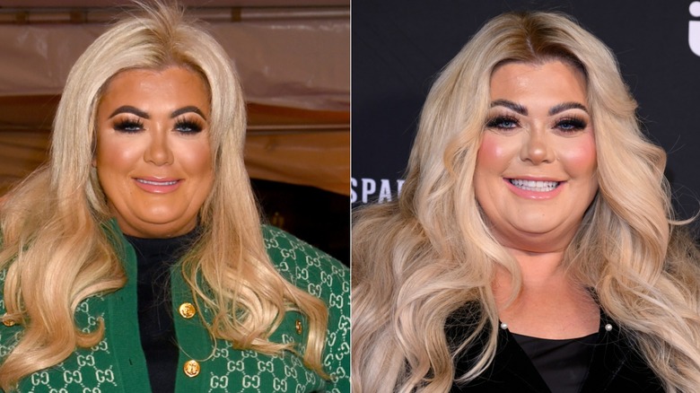 Foton sida vid sida som visar Gemma Collins före och efter användning av Botox