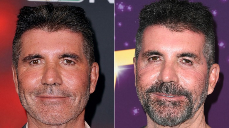 Simon Cowell före och efter att han löste upp sina ansiktsfyllmedel