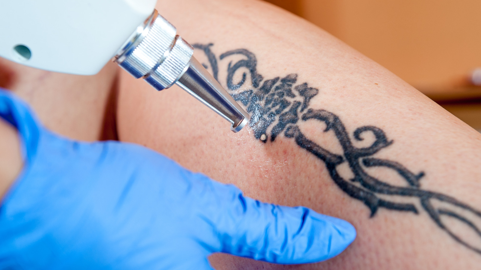 Millennials älskade tatueringar - nu gör de laserborttagning till nästa stora trend