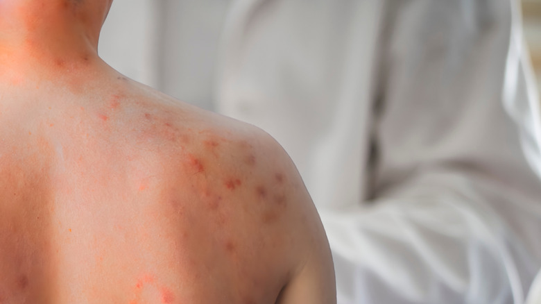 Mässlingsutslag på en patients rygg och axel